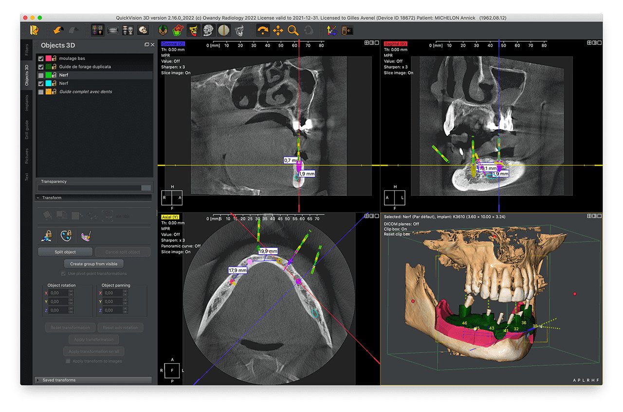 Owandy I-MAX 3D XPRO - Tomógrafo Dental 3D - Imagen 10