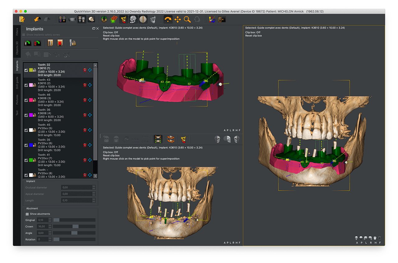 Owandy I-MAX 3D XPRO - Tomógrafo Dental 3D - Imagen 3