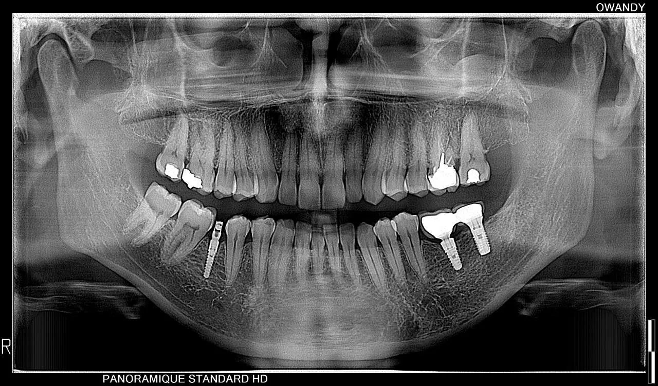 Owandy I-MAX 3D XPRO - Tomógrafo Dental 3D - Imagen 6