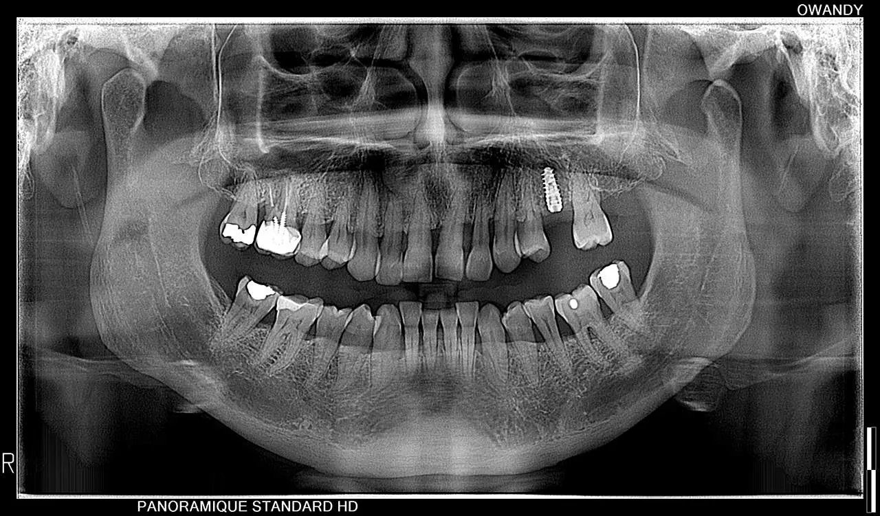 Owandy I-MAX 3D XPRO - Tomógrafo Dental 3D - Imagen 7
