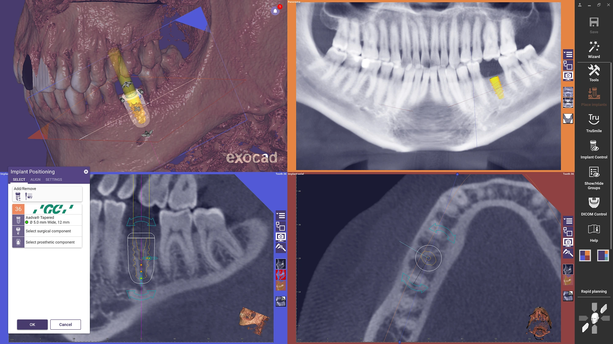 exoplan - Software de Planificación de Implantes