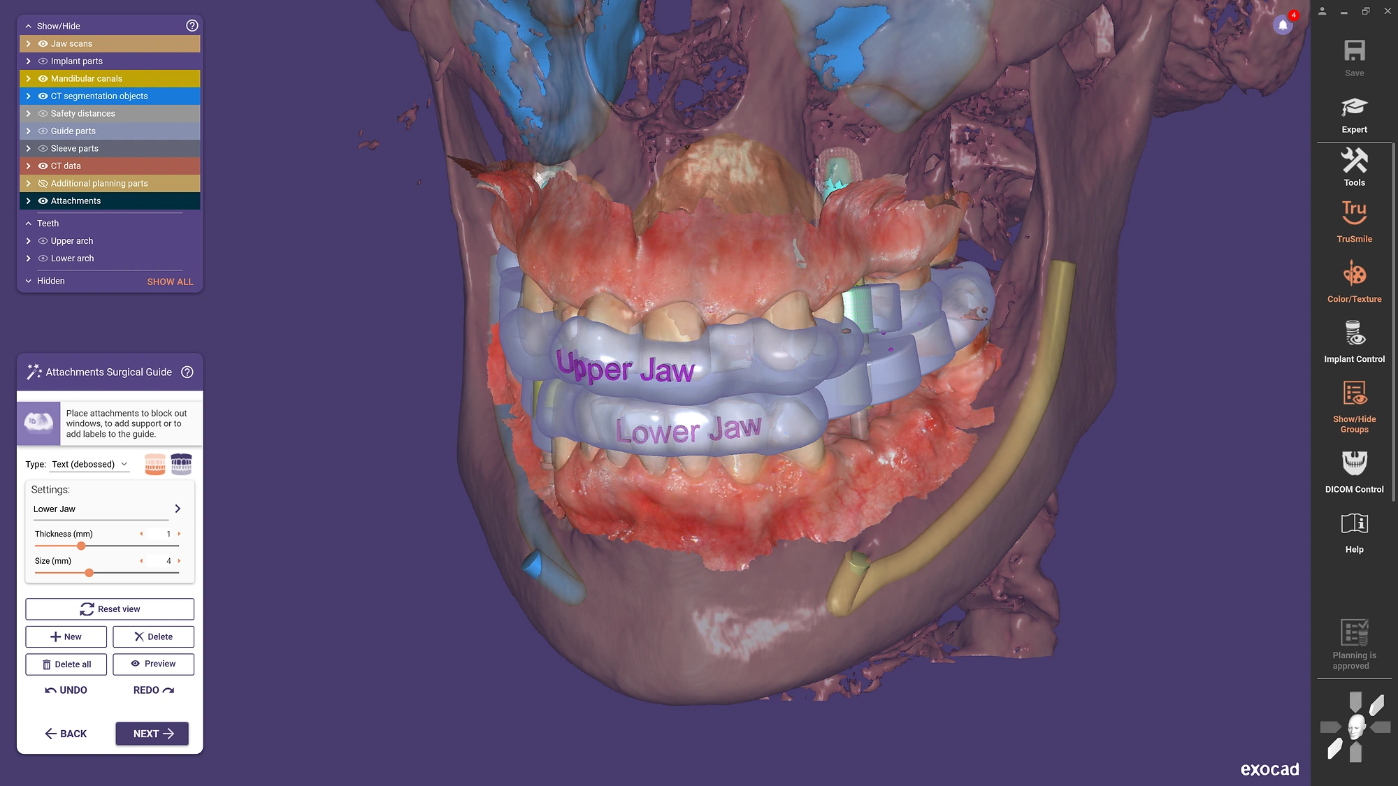 exoplan - Software de Planificación de Implantes - Imagen 3