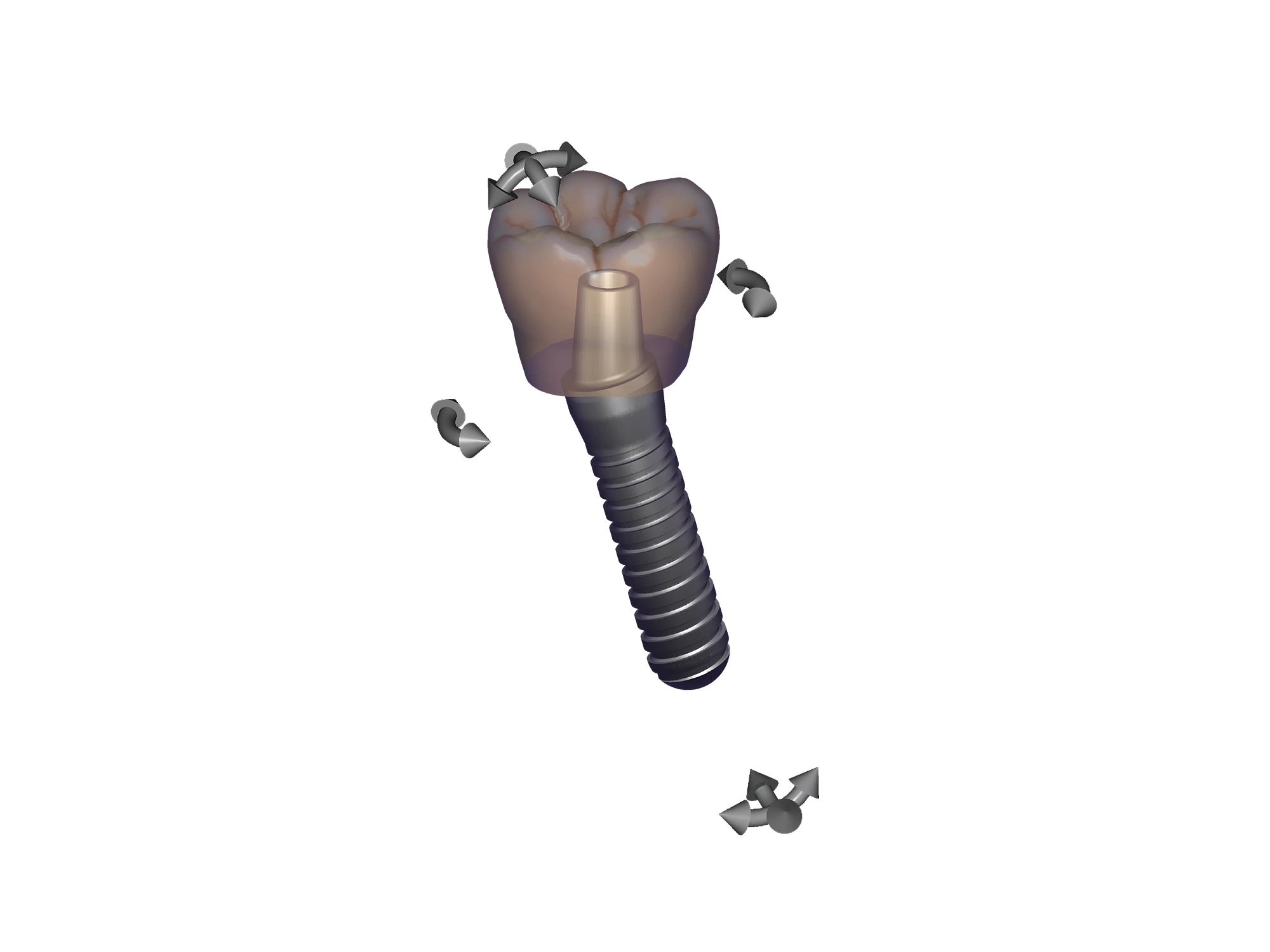 exoplan - Software de Planificación de Implantes - Imagen 5