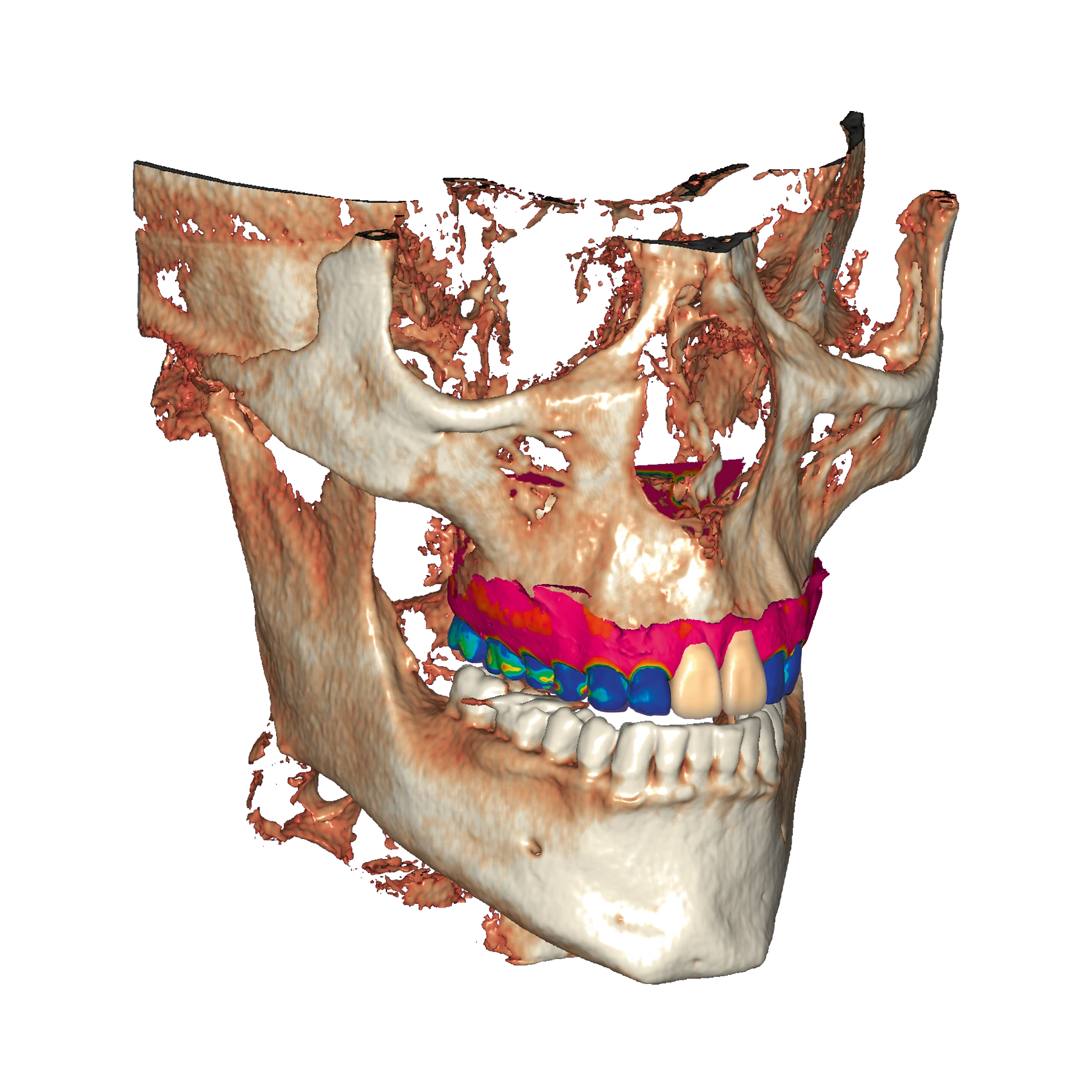 exoplan - Software de Planificación de Implantes - Imagen 10