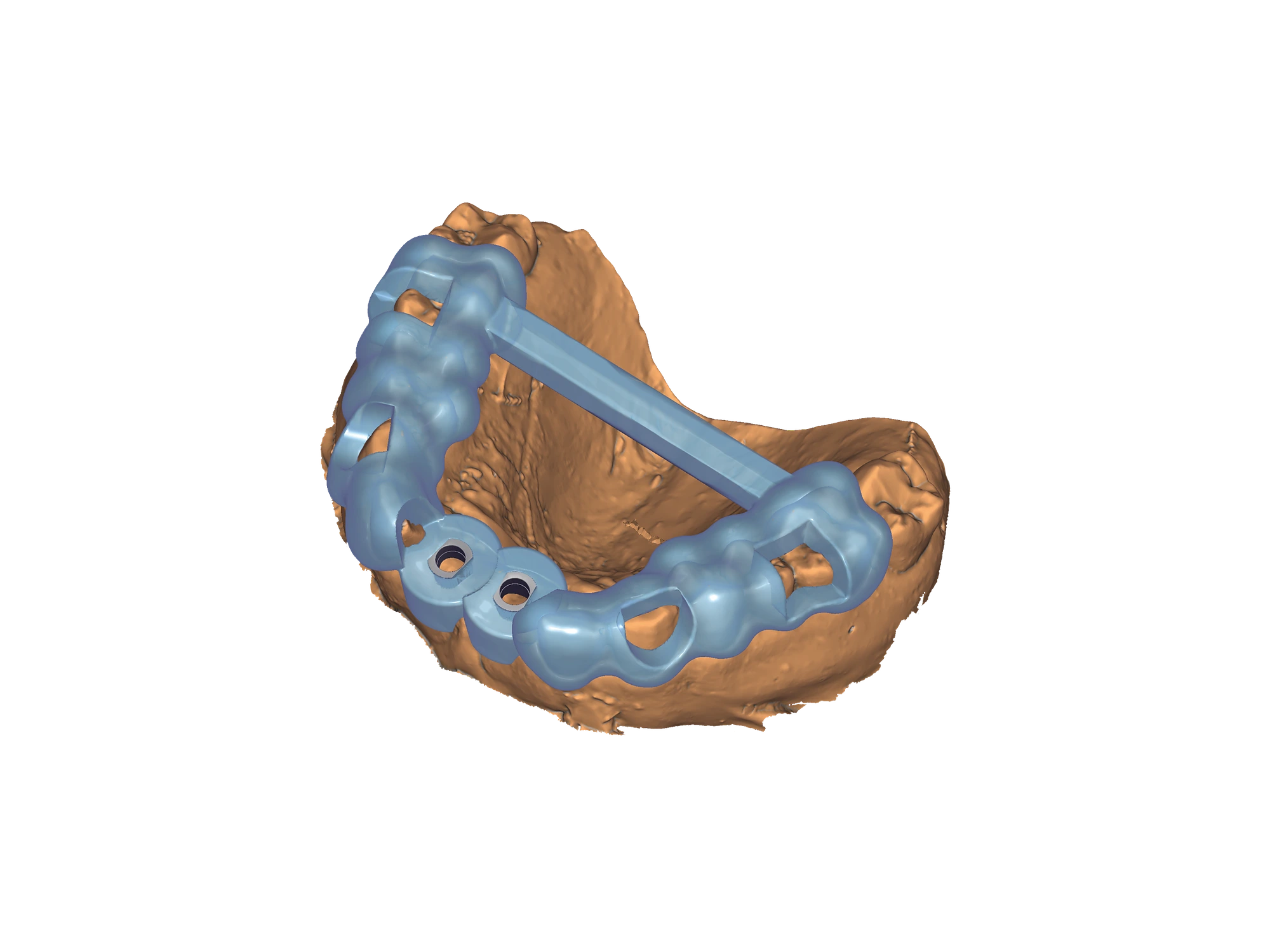 exoplan - Software de Planificación de Implantes - Imagen 8