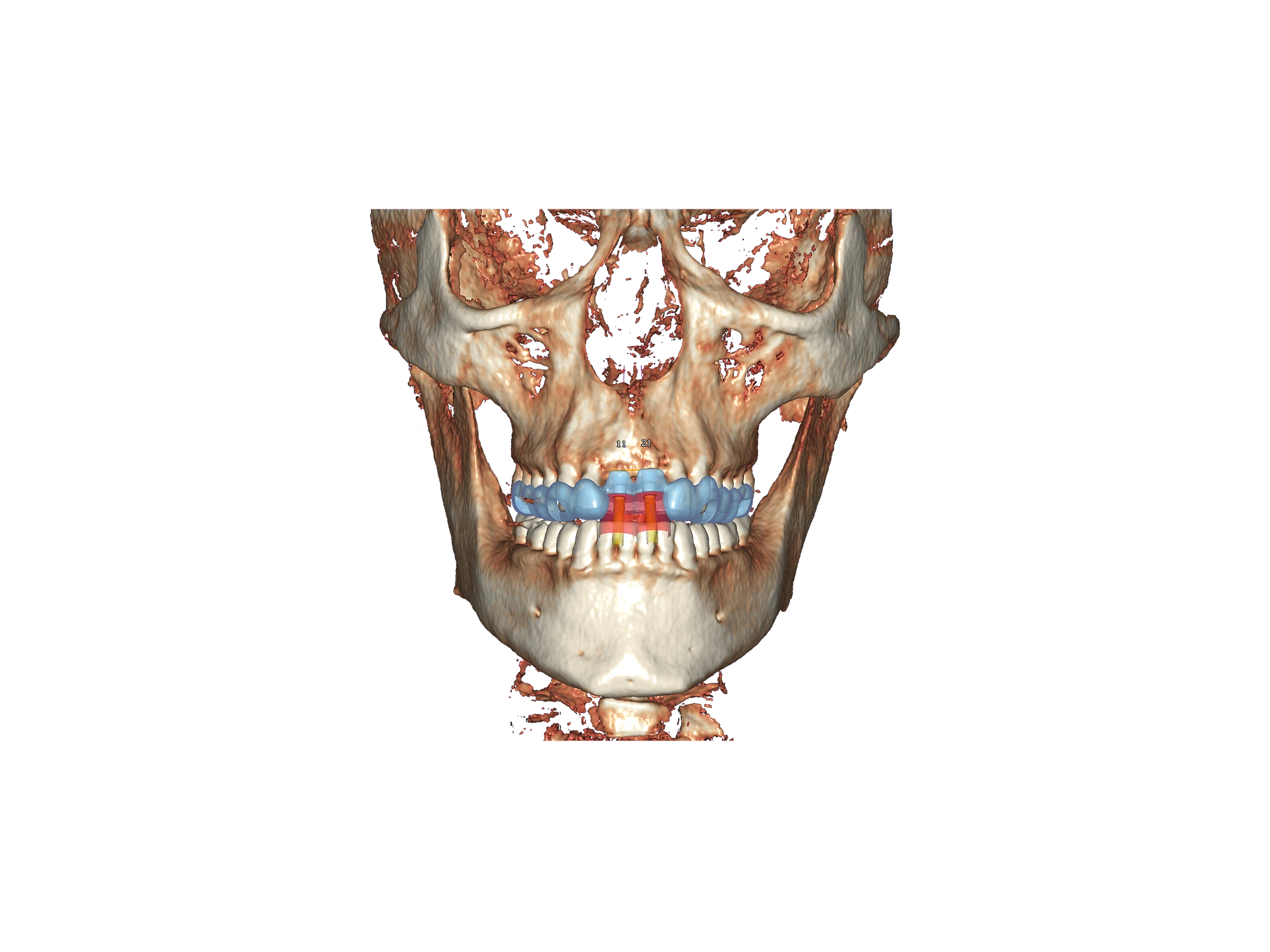 exoplan - Software de Planificación de Implantes - Imagen 4